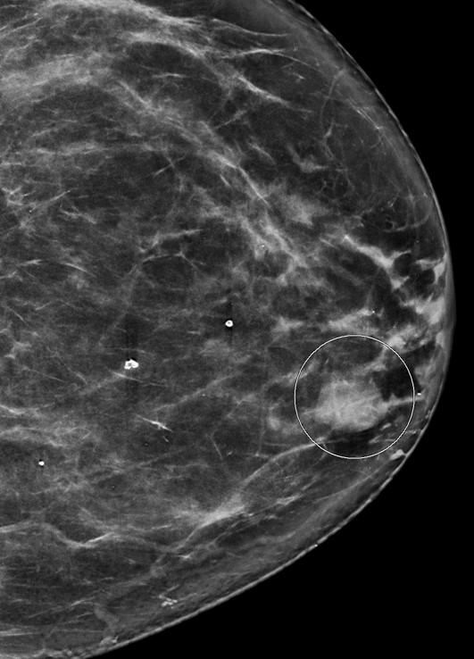 Mammogram of the left breast mass