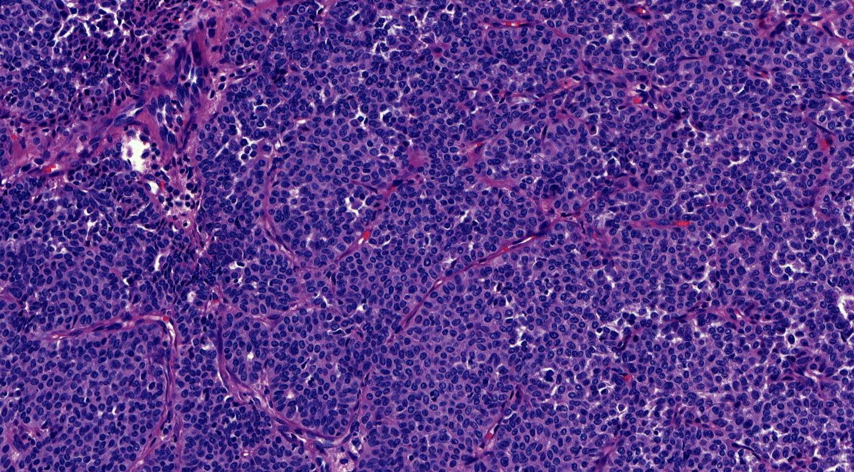 Fibrovascular cores within  epithelial proliferation