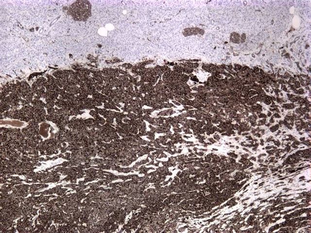 Solid pseudopapillary neoplasm, pancreas