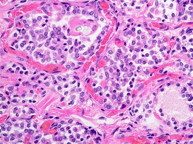 Neoplasm: Hurtle Cell Neoplasm
