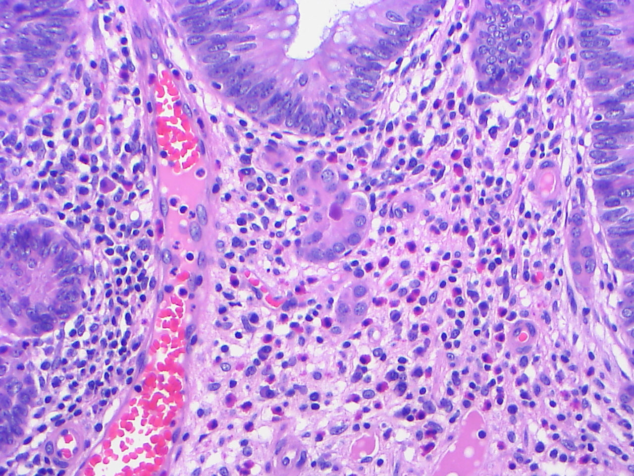 Colonic tubulovillous adenoma with microcarcinoids