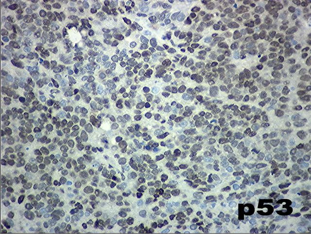 Fordított urothelialis papilloma p53