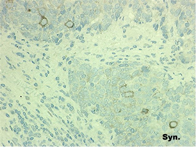 Thymic carcinoma (type C thymoma), nonkeratinizing squamous cell carcinoma type
