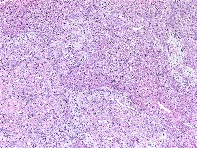 Hepatocytes in myxoid stroma