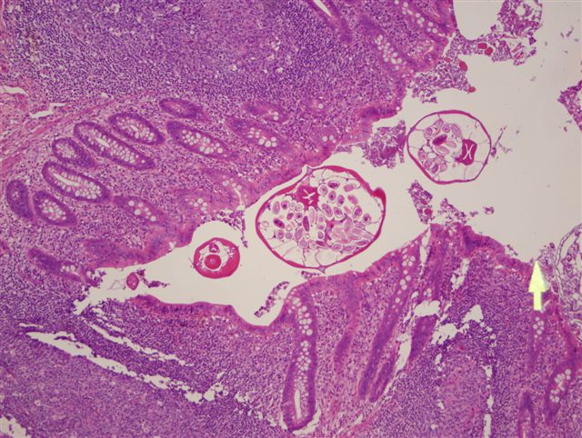 enterobius vermicularis appendix îndepărtarea verucilor genitale prin vindecarea undelor radio