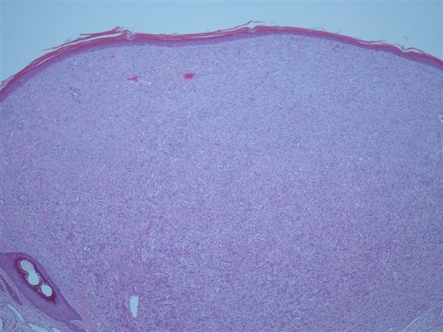 60 year old man with scalp lesion