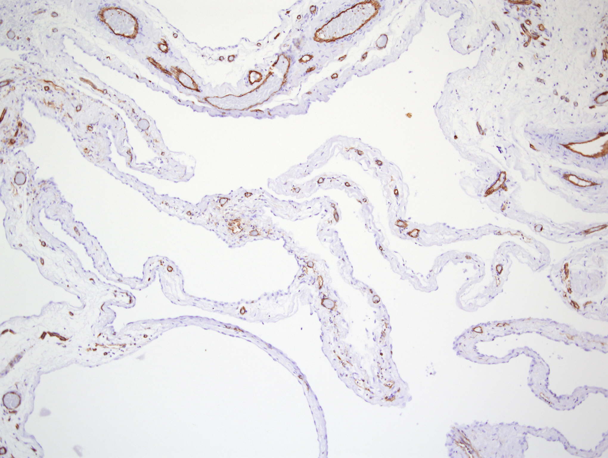 apoptosis in mesothelioma cells