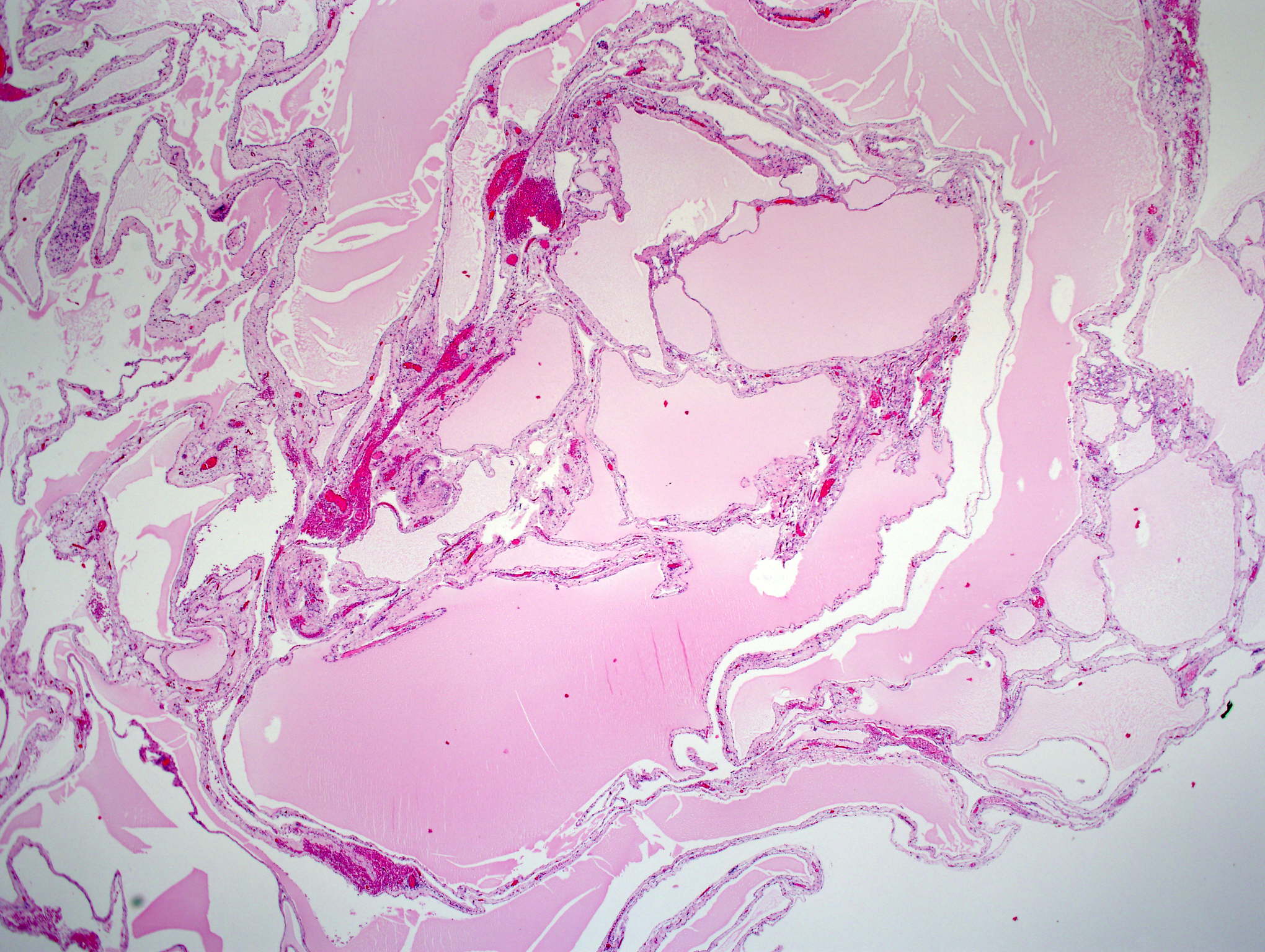squamous cell carcinoma of the esophagus epithelium