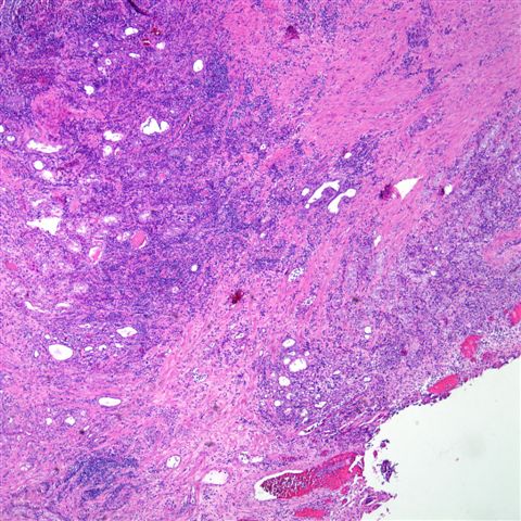 Papillary urothelial hyperplasia, Papillary urothelial hyperplasia