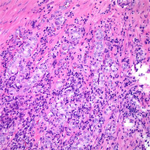 mesonephric adenoma pathology outlines prostata anatomia