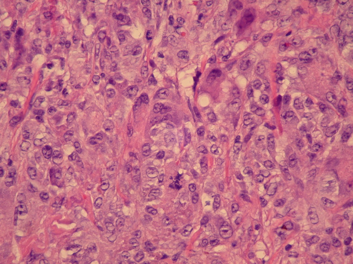 characteristics of squamous cell carcinoma esophagus