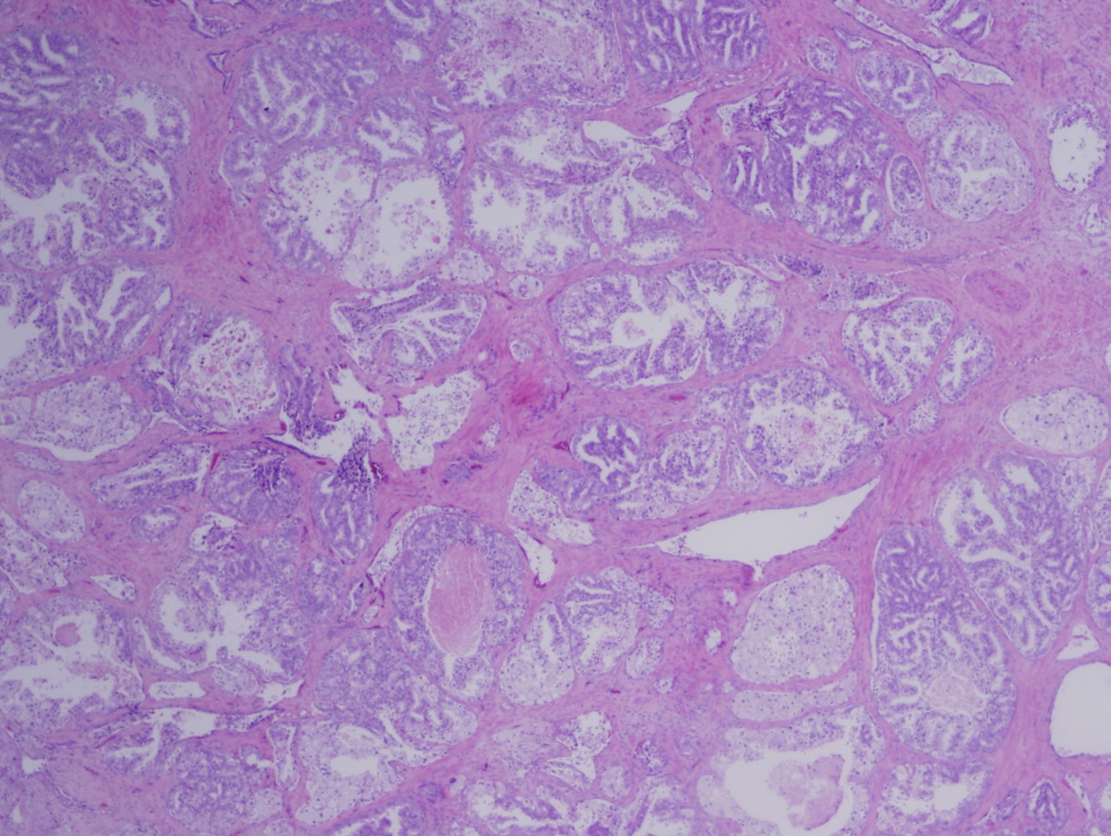 prostate intraductal adenocarcinoma pathology outlines Arginin és prostatitis