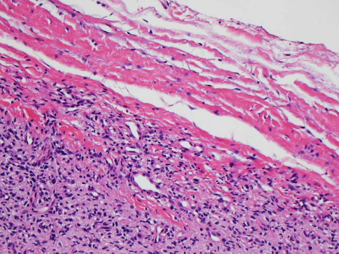 Circumscribed spindle cell tumor