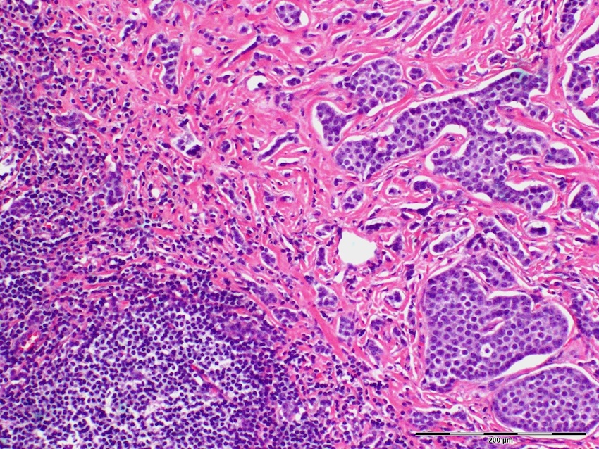 adenocarcinoma with neuroendocrine differentiation pathology outlines