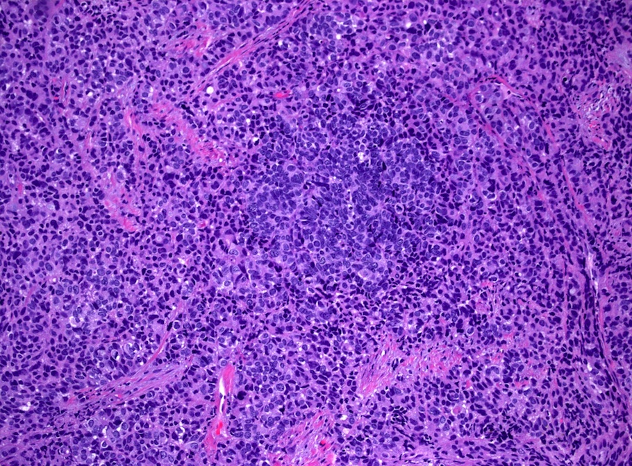adenocarcinoma with neuroendocrine differentiation pathology outlines Gyertyák a prosztatitisből a férfiak listájában