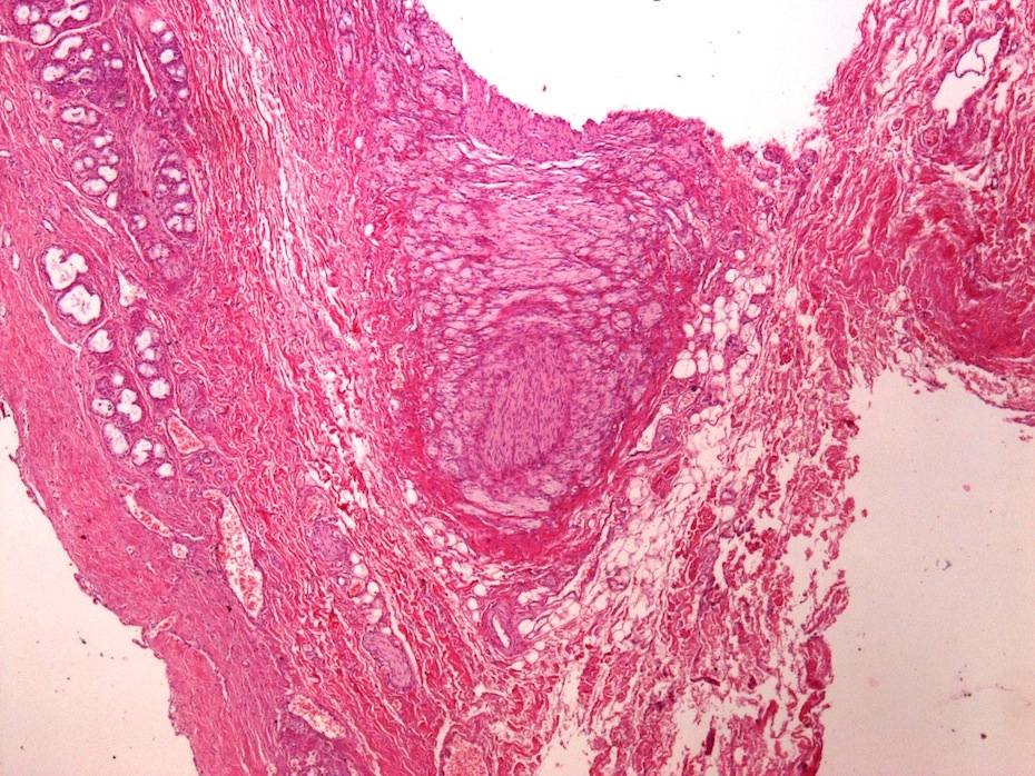 Low power view of solid, well circumscribed lesion
