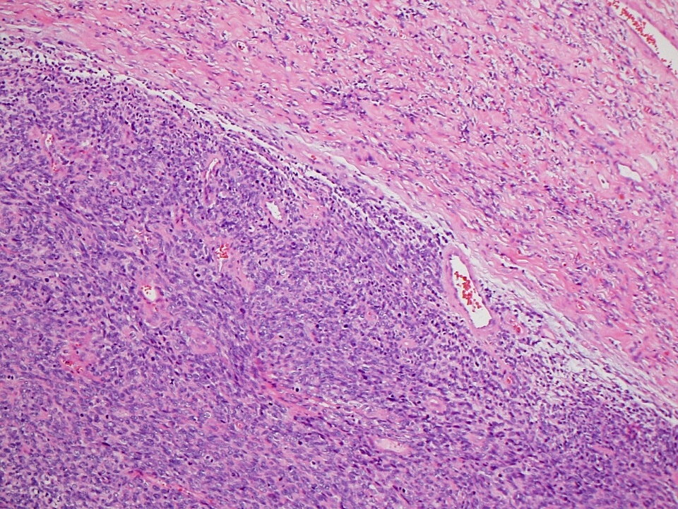 mesothelioma diagnostic criteria