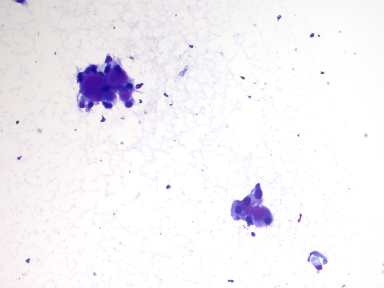 Stromal globules (Diff-Quik stain)