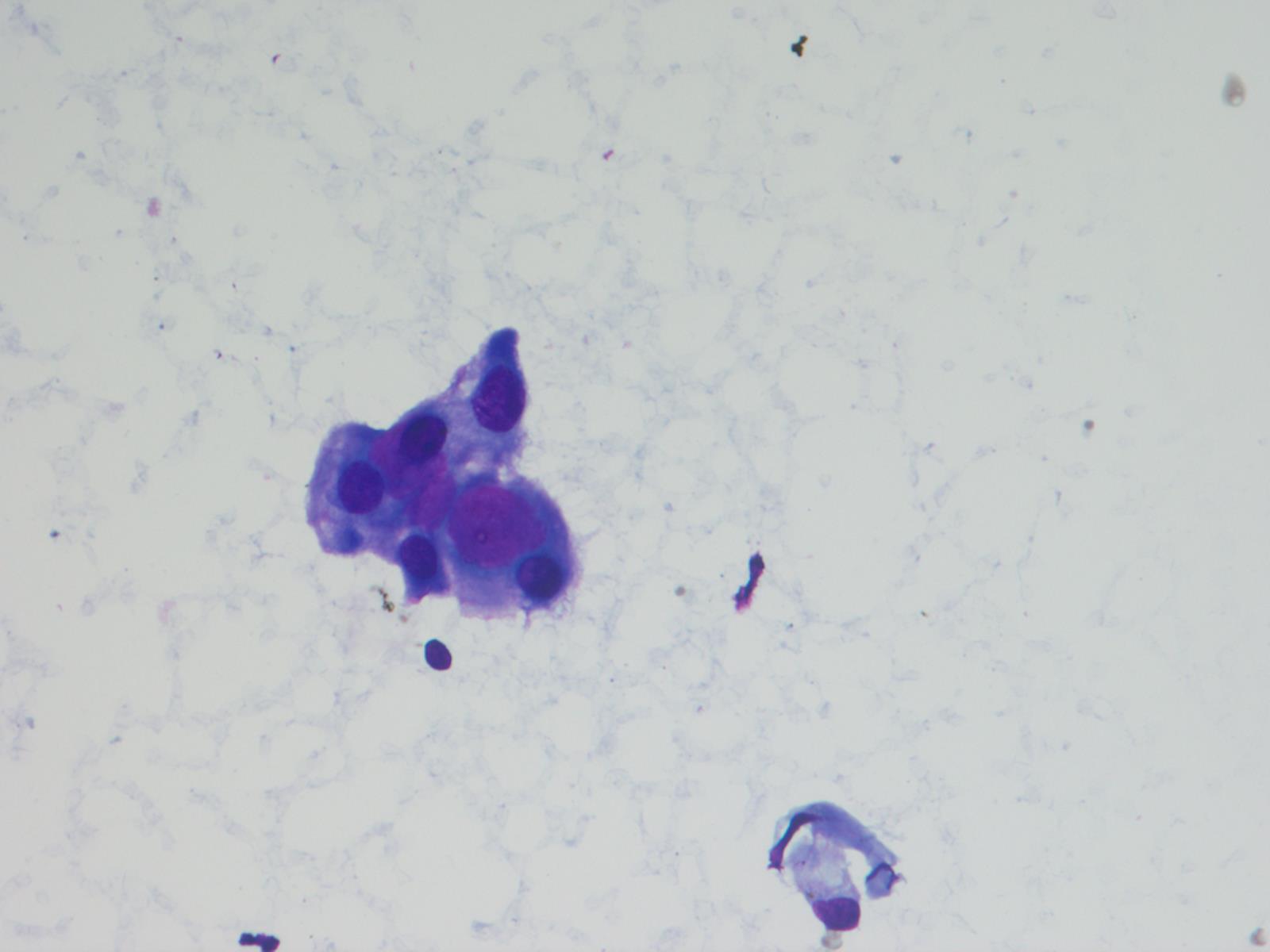 Stromal globules (Diff-Quik stain)