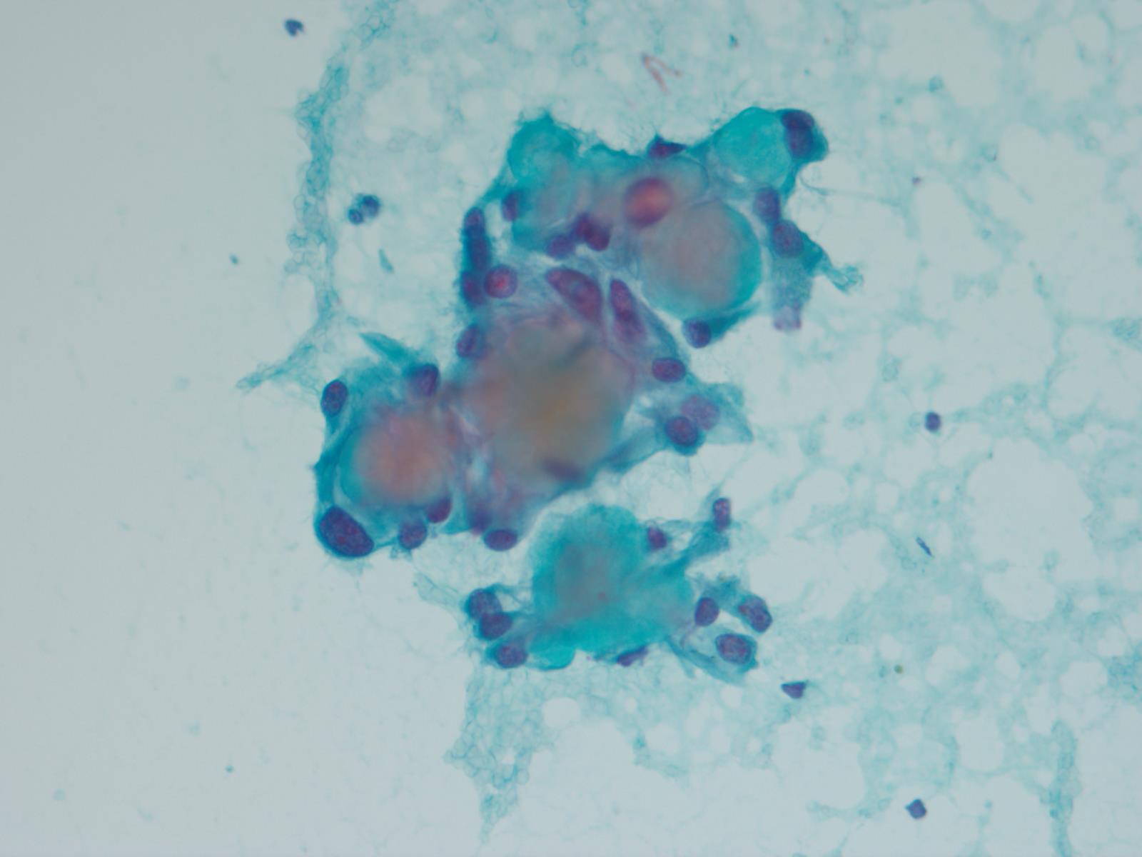 Stromal globules (Pap stain)