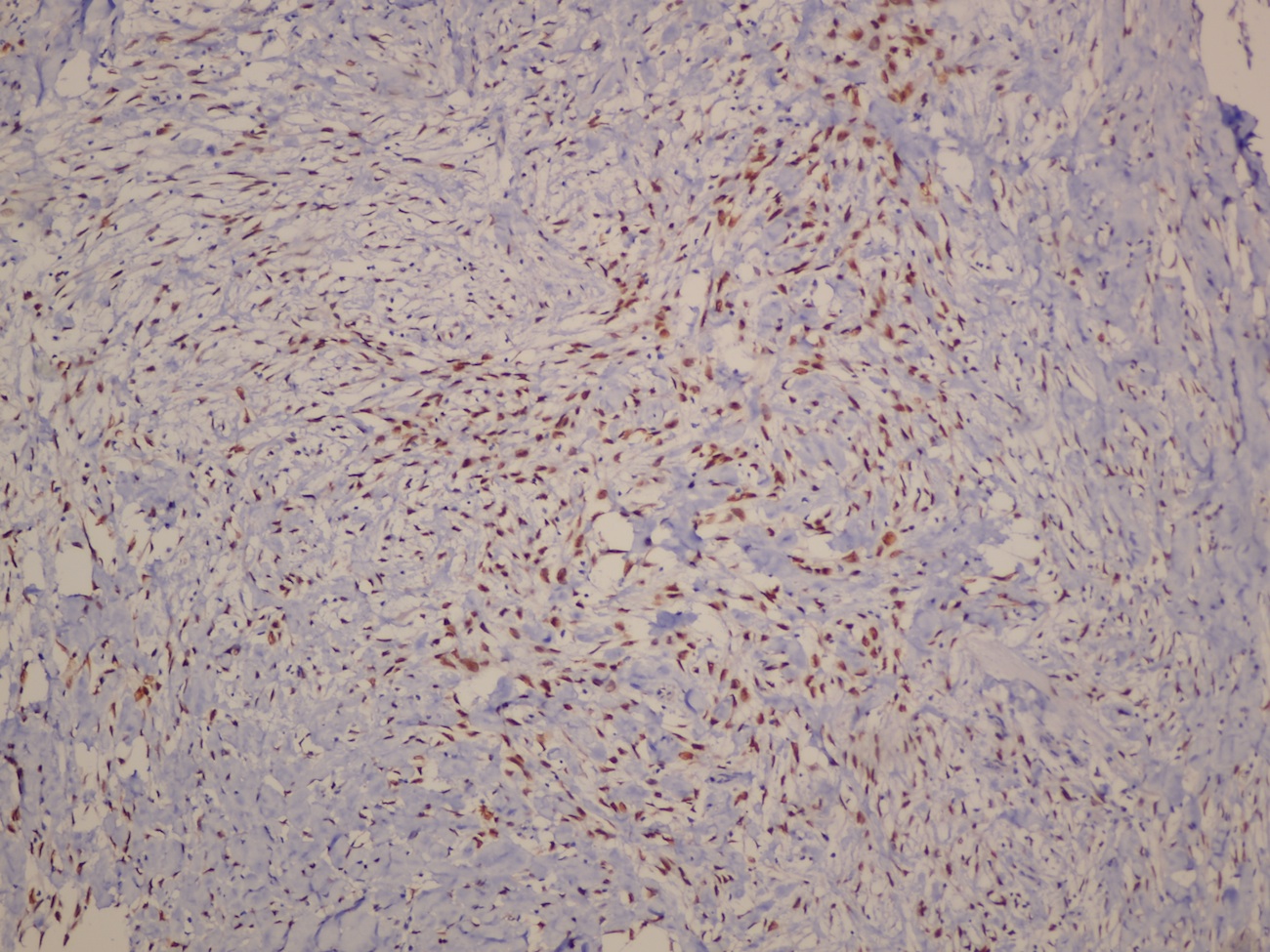 Tumor cells positive for p63 IHC