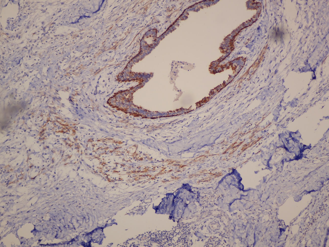 Tumor cells positive for CK 5/6 IHC