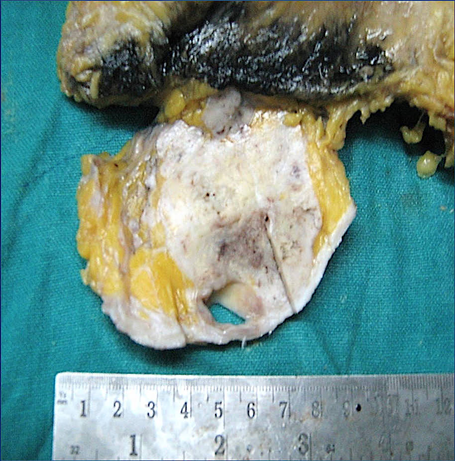 Malignant adenomyoepithelioma
