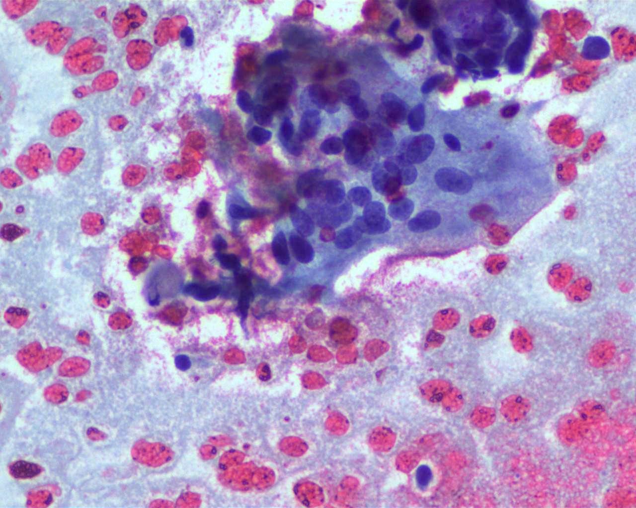 Giant cell in smear