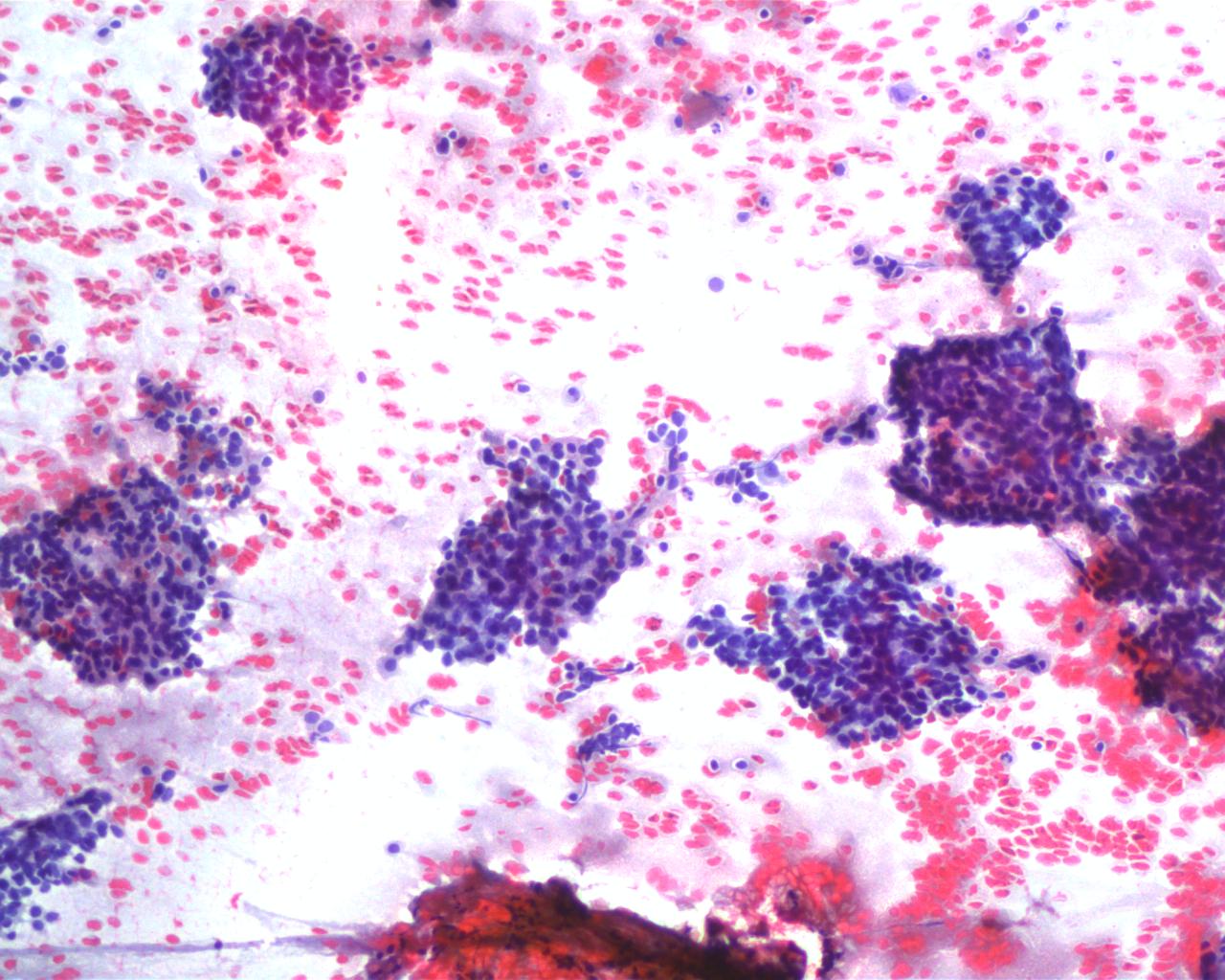 Basaloid cell smear