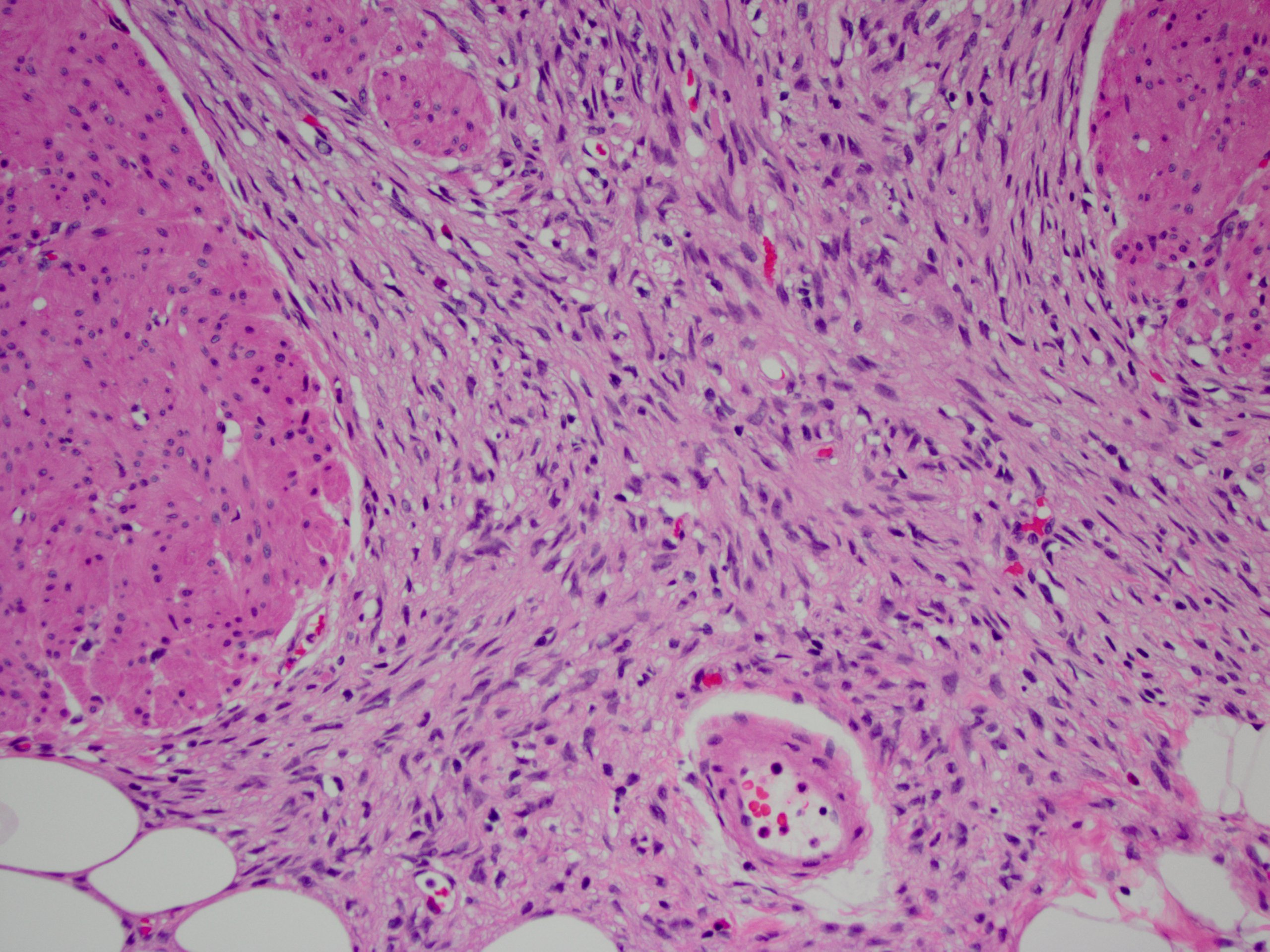 Pathology Outlines Gastrointestinal Stromal Tumor GIST Of Colon.