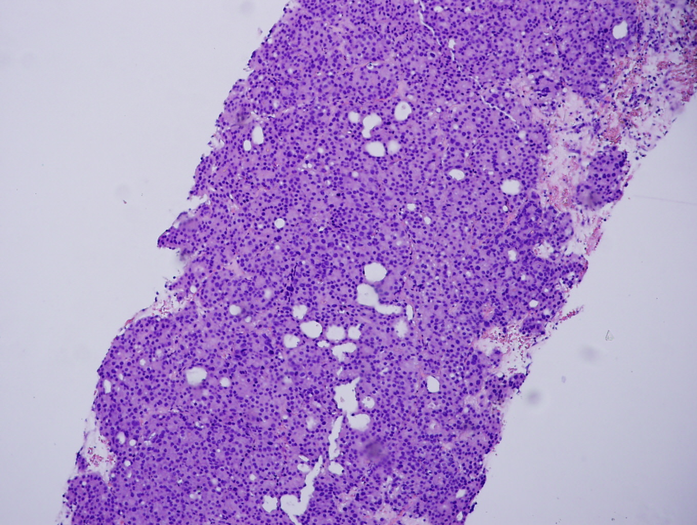 Papilloma of skin histology. Squamous papilloma skin pathology outlines. Skin Cancer