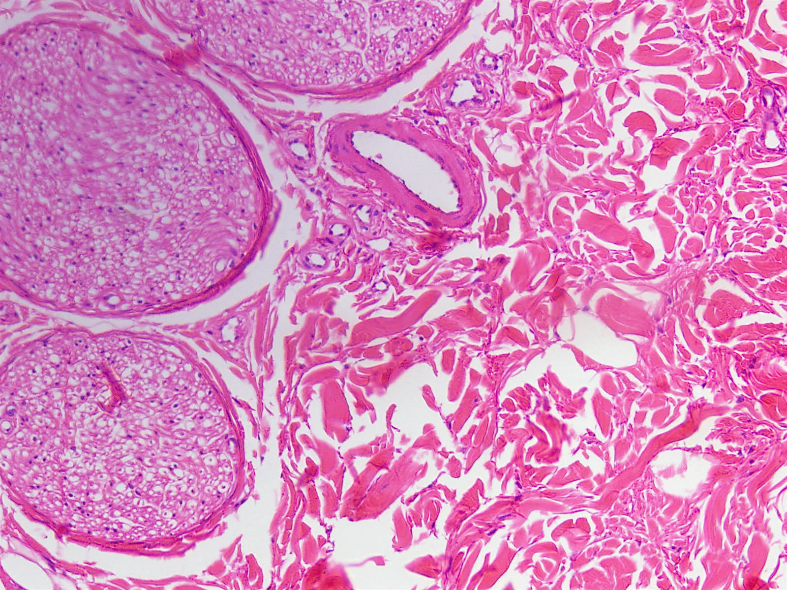 1600 x 1200 - jpeg. pathology outlines nuchal type gardner fibroma. 