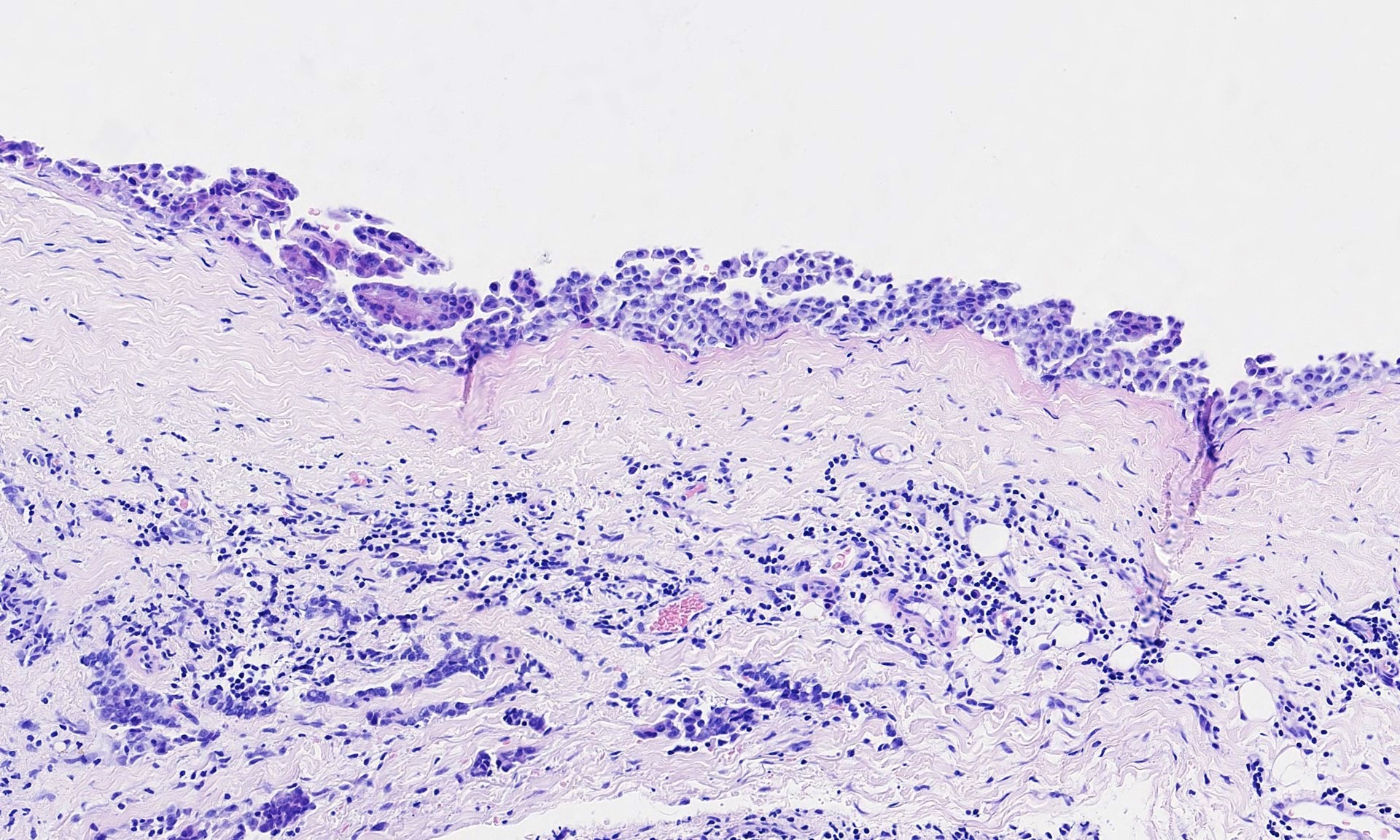 how to identify squamous cell carcinoma