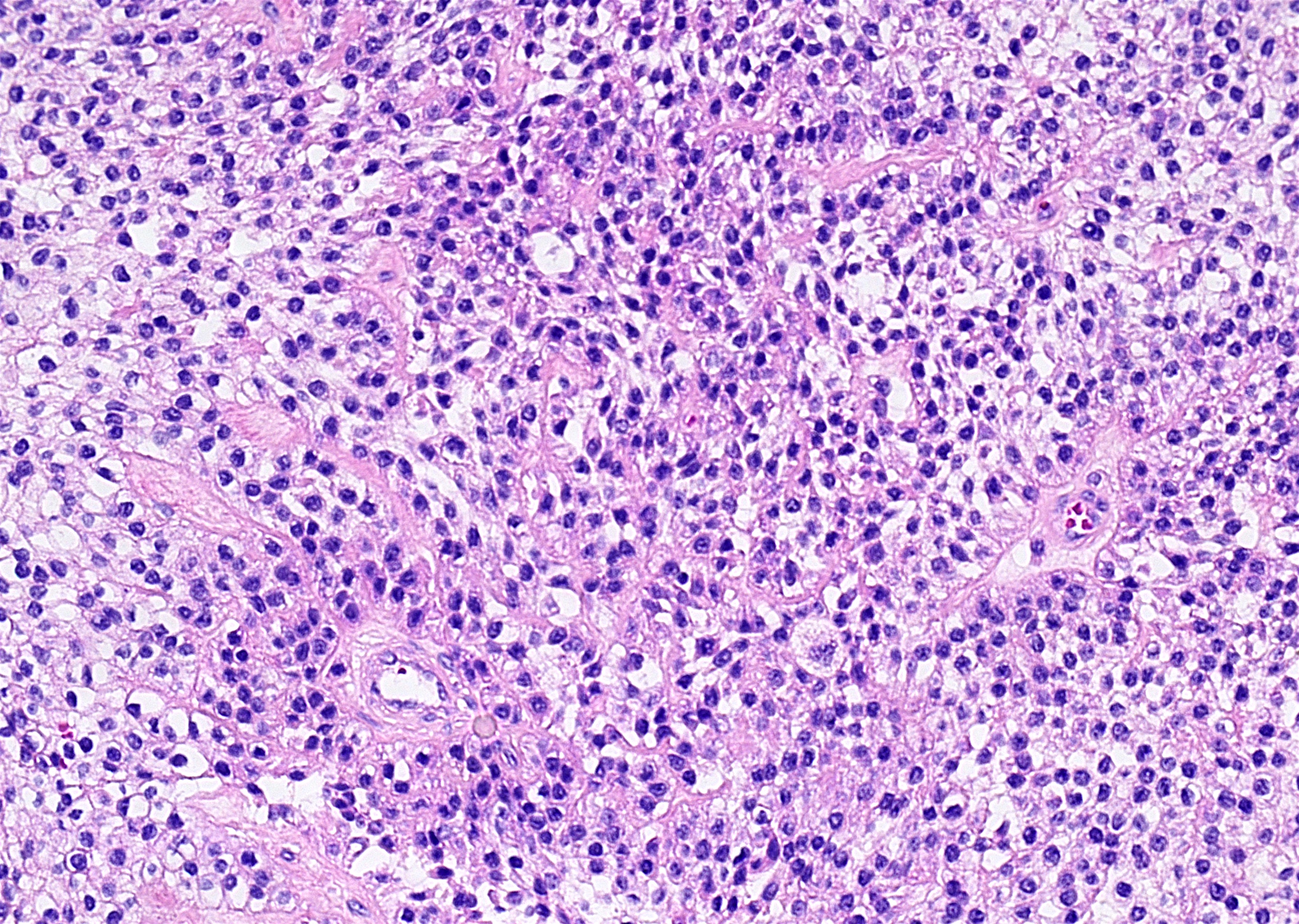 adenocarcinoma nos salivary gland pathology outlines
