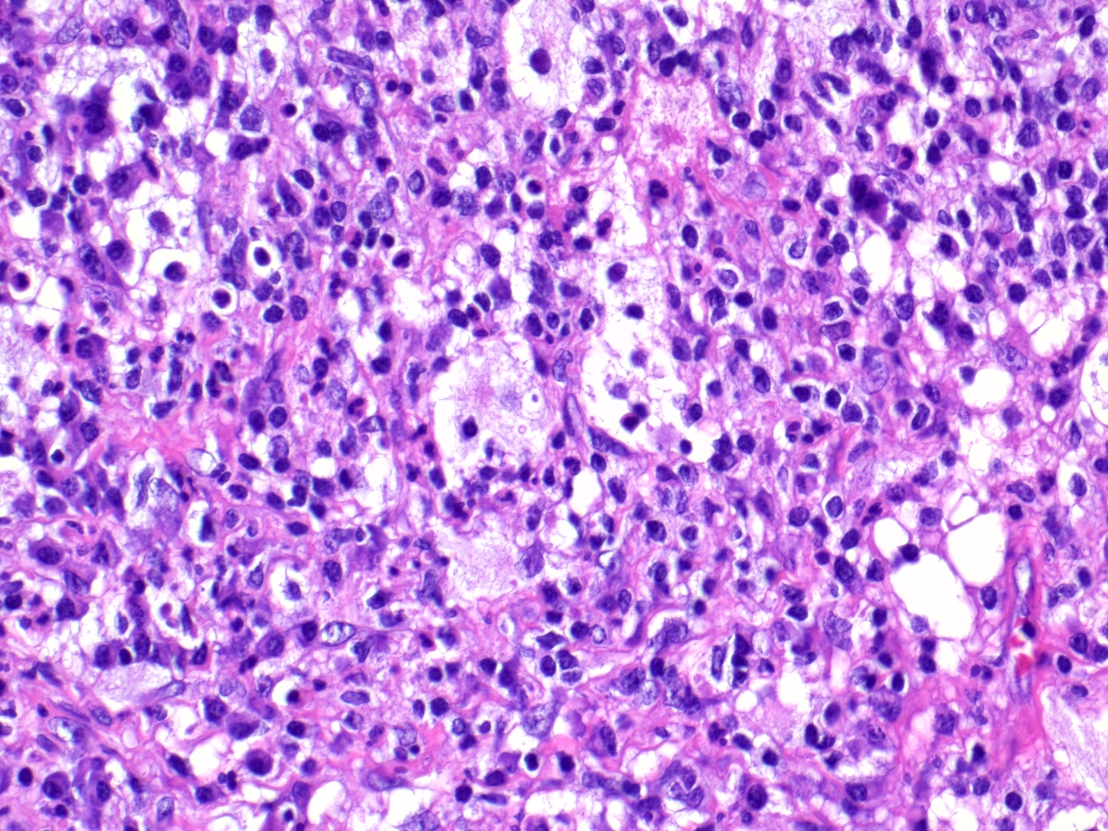 Pathology Outlines Histiocytic Tumors
