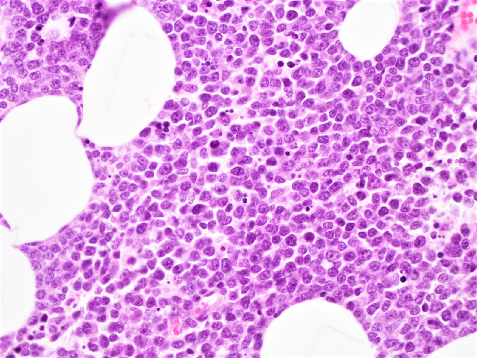 H&E stained section of the abdominal wall mass