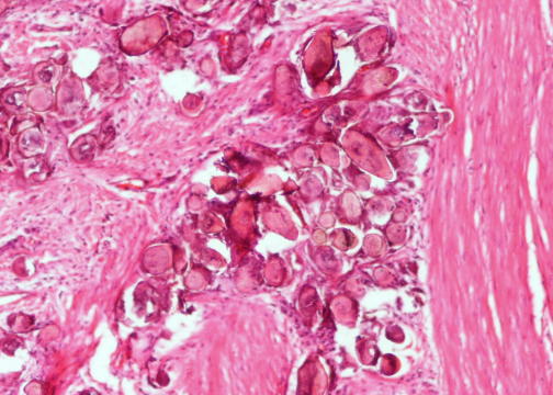 schistosomiasis gallbladder recenzii bune de medicamente antihelmintice
