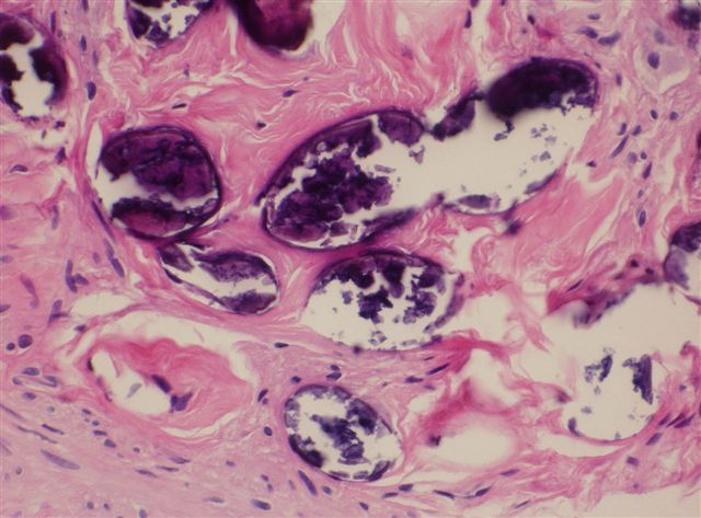 schistosomiasis pathology outlines