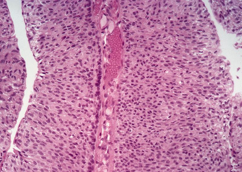 papillary urothelial neoplasia negi genitale în forul bărbaților