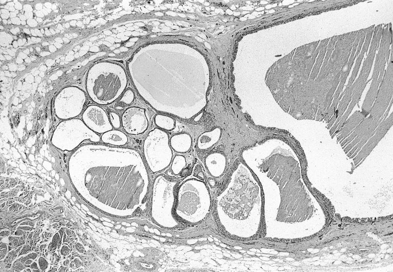Lobulated cystic structure lined by benign epithelium