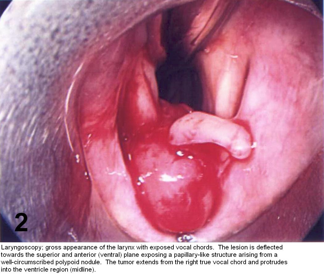 cancer laringian malign papiloma intraductal bi rads 4