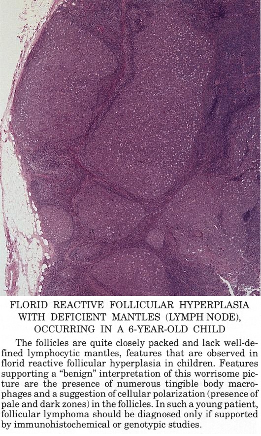 Pathology Outlines Follicular Hyperplasia