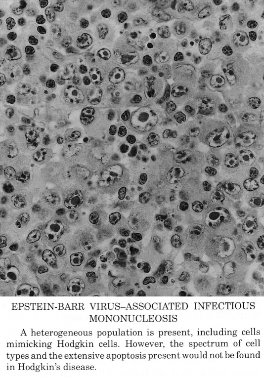 Pathology Outlines - Epstein Barr virus