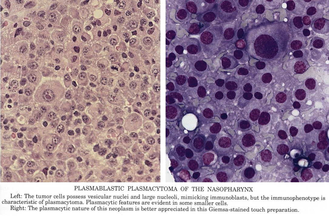 Pathology Outlines - Plasmacytoma
