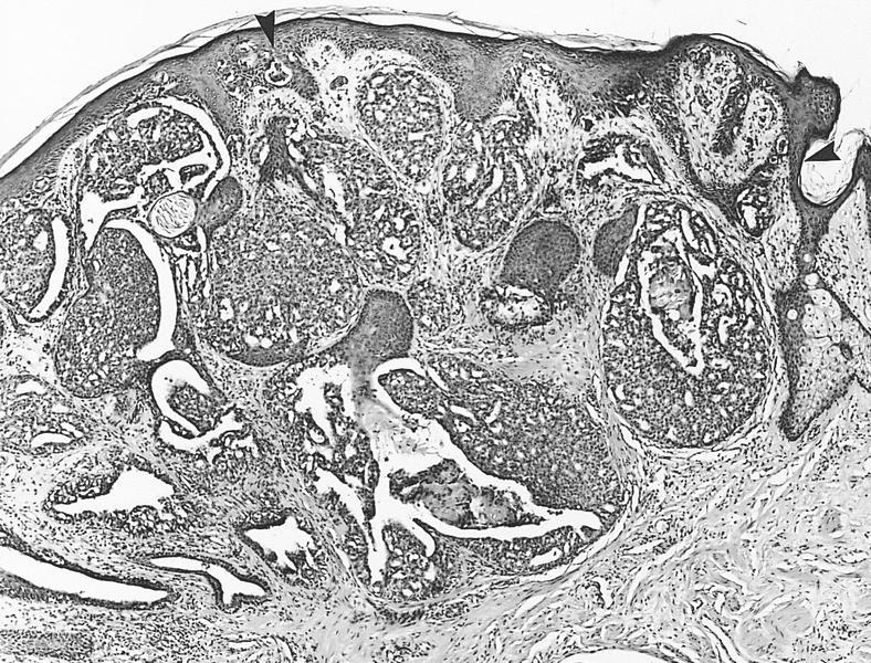 florid papillomatosis of the nipple pathology outlines