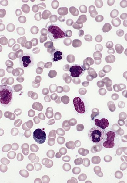 Blood shows mature monocytes and neutrophils