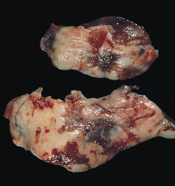 External surfaces of the ovarian wedges show red, blue and brown areas, some associated with fibrotic puckering