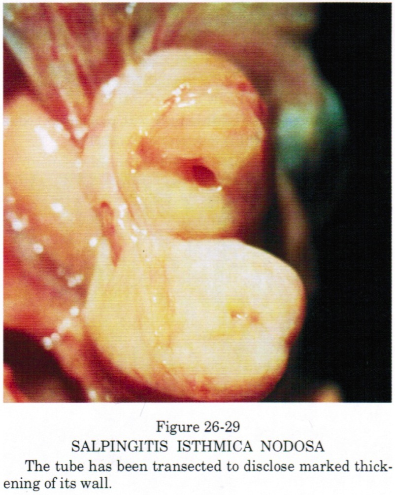 Pathology Outlines - Salpingitis isthmica nodosa