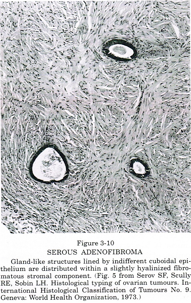 papilloma ovary