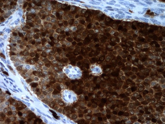 Ovarian granulosa cell tumor (adult)
